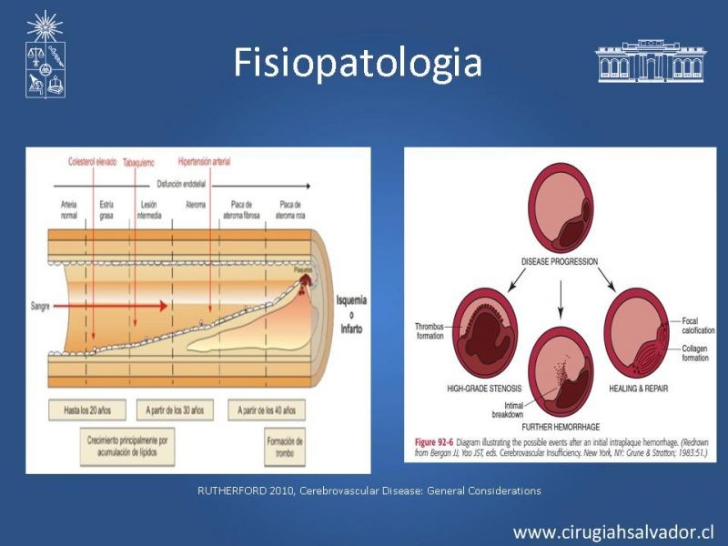 Diapositiva 6 de Estenosis Carotídea Sintomática