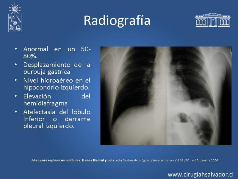 Diapositiva 9 de Abscesos esplénicos