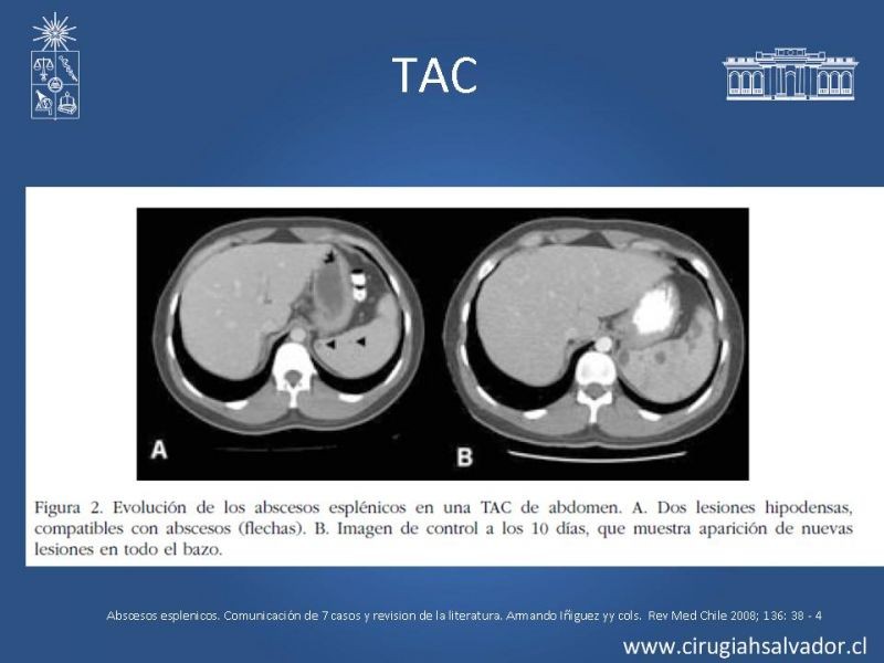Diapositiva 11 de Abscesos esplénicos