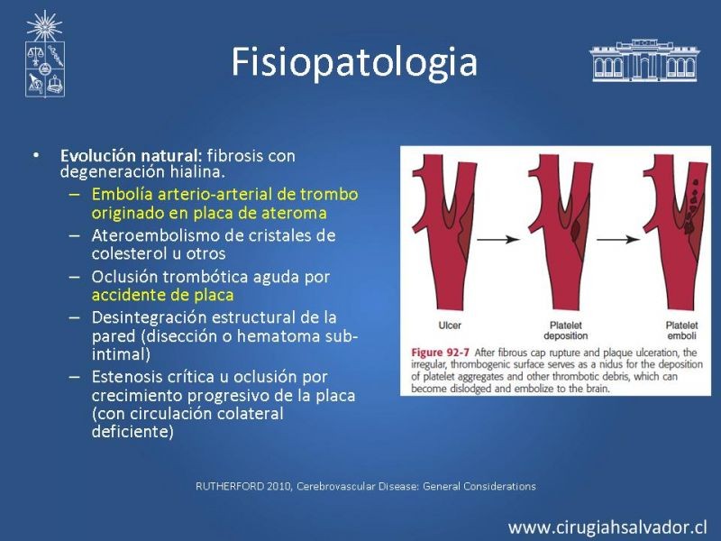 Diapositiva 5 de Estenosis Carotídea Sintomática