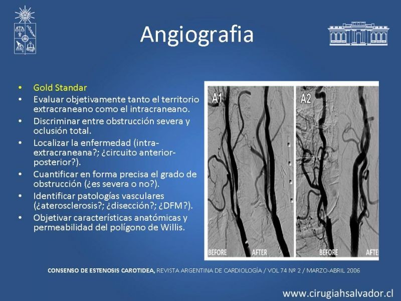 Diapositiva 10 de Estenosis Carotídea Sintomática