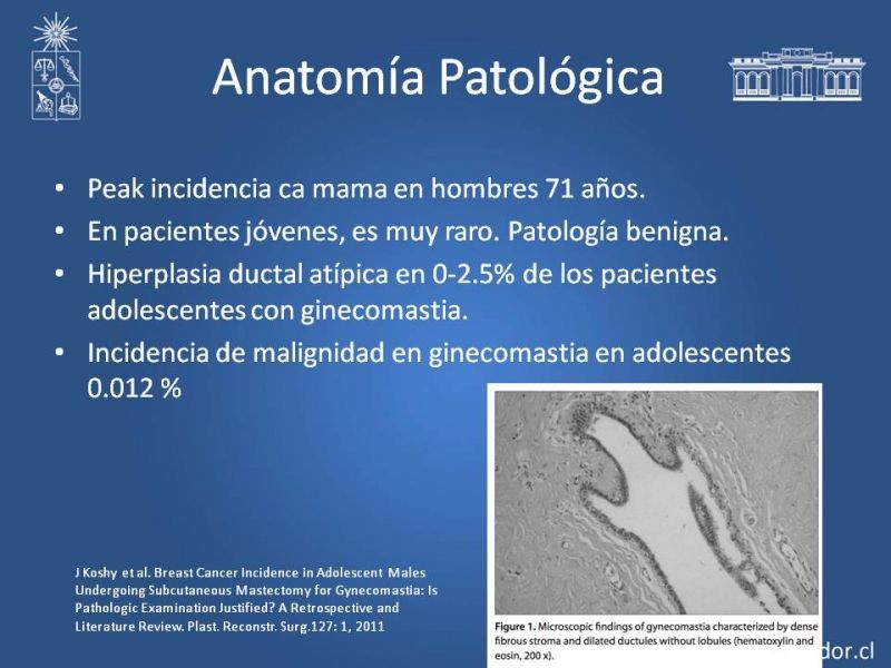 Diapositiva 21 de Ginecomastia