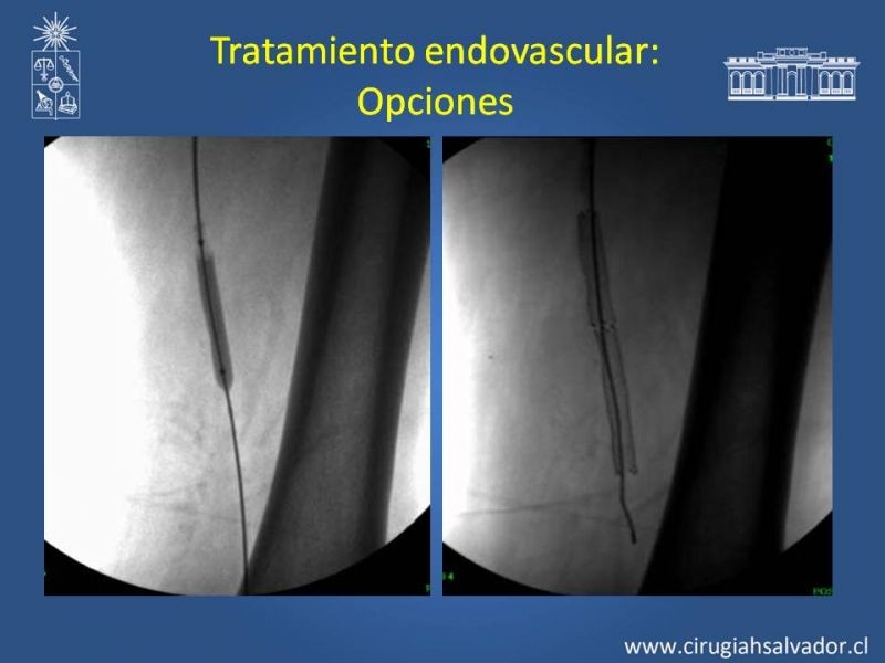 Diapositiva 14 de Tratamiento Endovascular: EAO femoro-distal