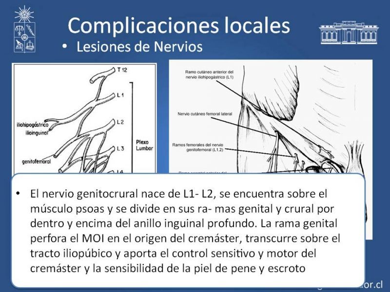 Diapositiva 13 de Complicaciones de la Cirugía Herniaría