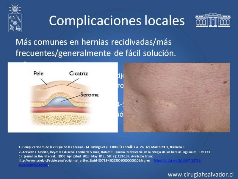 Diapositiva 7 de Complicaciones de la Cirugía Herniaría