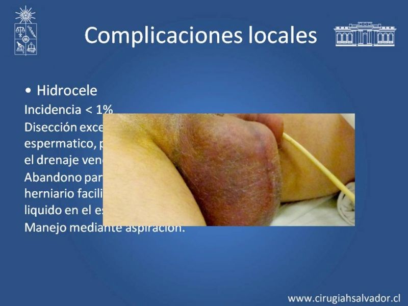 Diapositiva 8 de Complicaciones de la Cirugía Herniaría