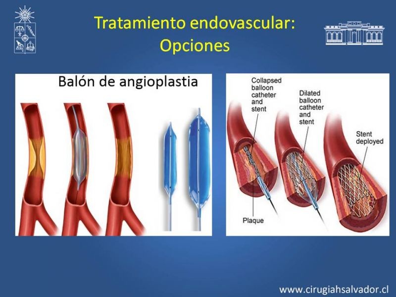 Diapositiva 13 de Tratamiento Endovascular: EAO femoro-distal