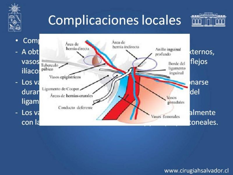 Diapositiva 11 de Complicaciones de la Cirugía Herniaría