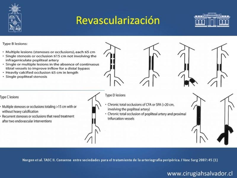 Diapositiva 7 de Tratamiento Endovascular: EAO femoro-distal