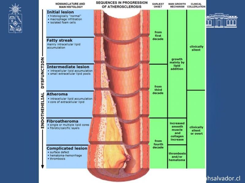 Diapositiva 4 de Estenosis Carotidea