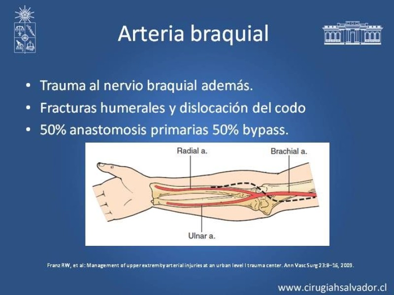 Diapositiva 17 de Trauma Vascular: Extremidades