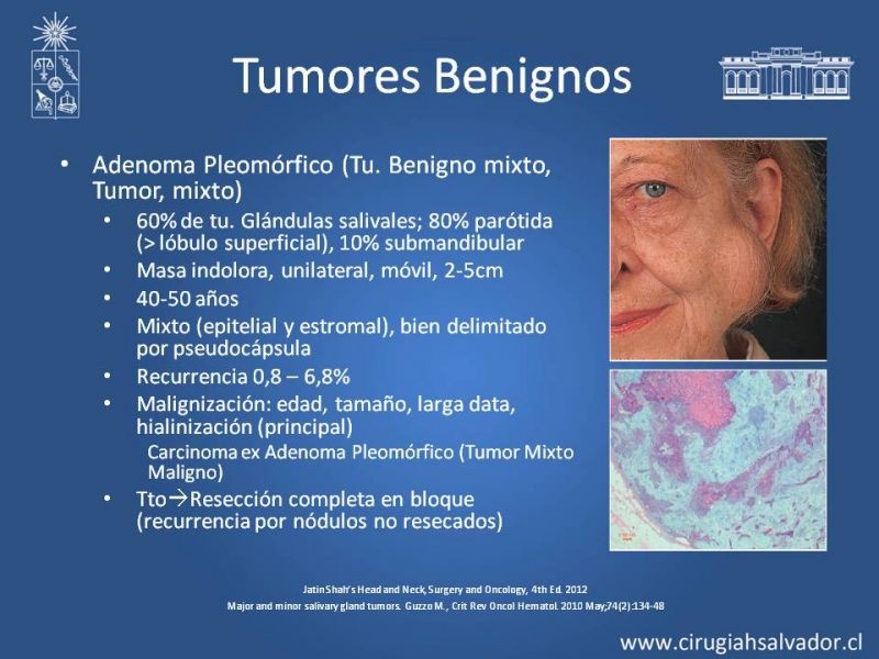 Diapositiva 13 de Tumores de Glándulas Salivales