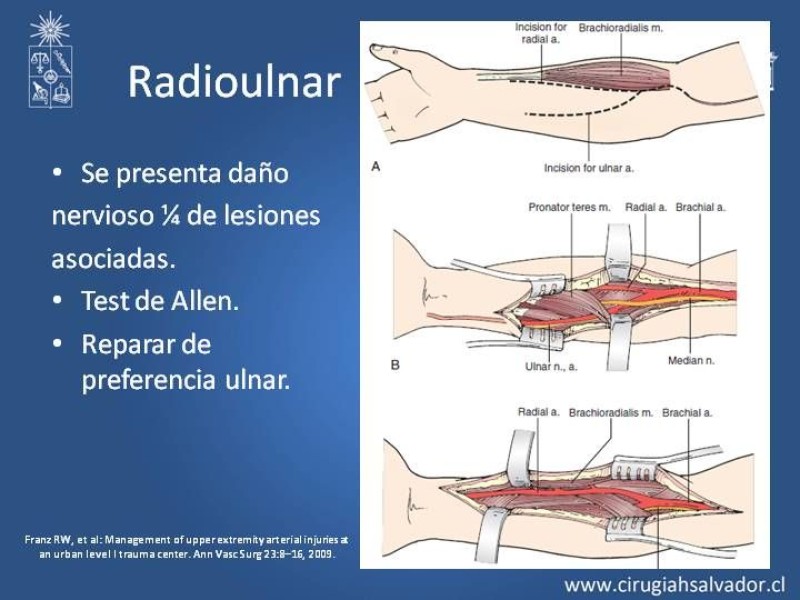 Diapositiva 18 de Trauma Vascular: Extremidades