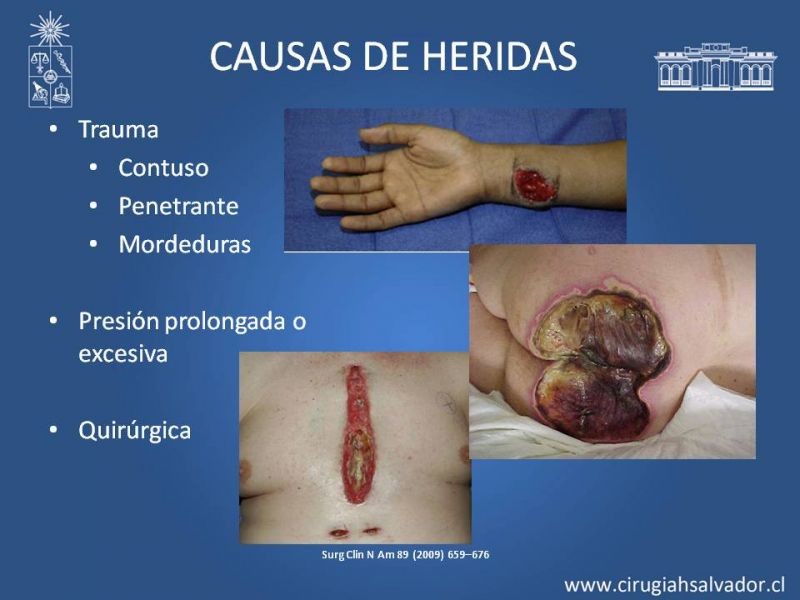 Diapositiva 4 de Curación avanzada de heridas
