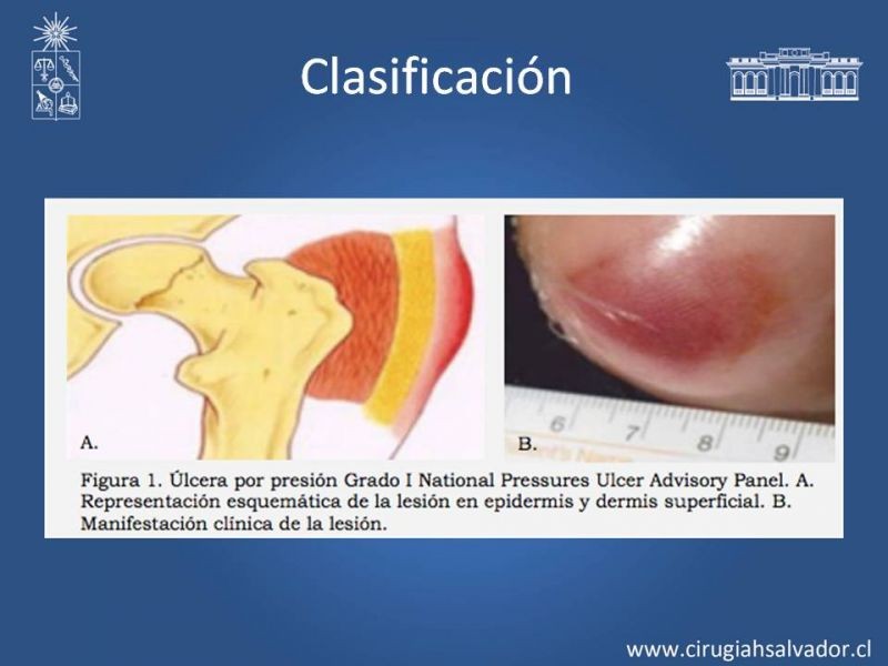 Diapositiva 4 de Manejo quirúrgico de las úlceras por presión