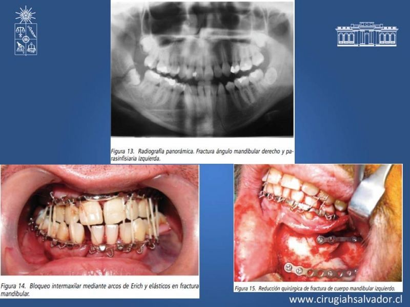 Diapositiva 22 de Trauma maxilofacial