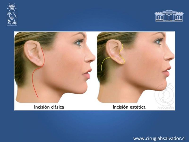 Diapositiva 21 de Tumores de parótida
