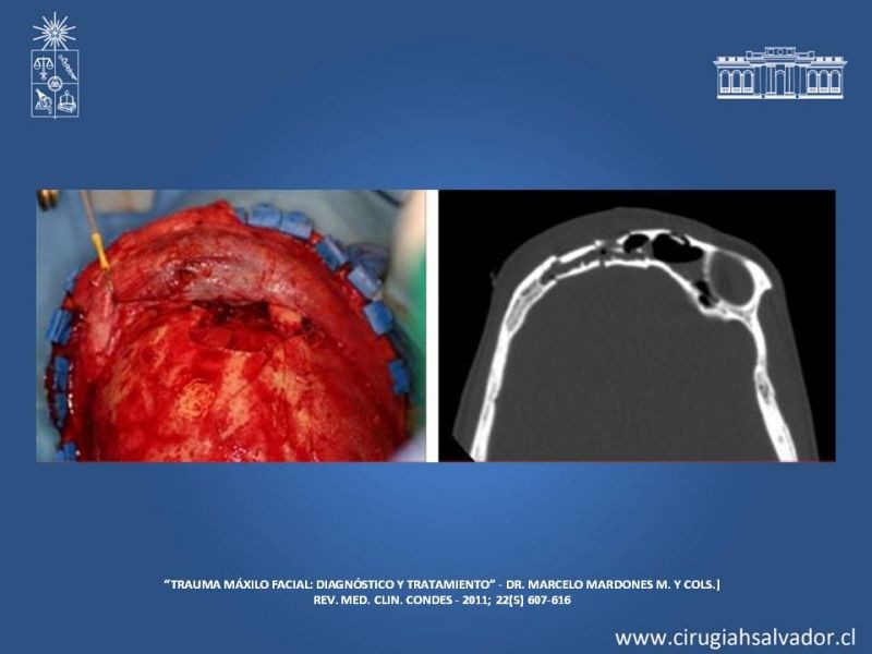 Diapositiva 4 de Trauma maxilofacial