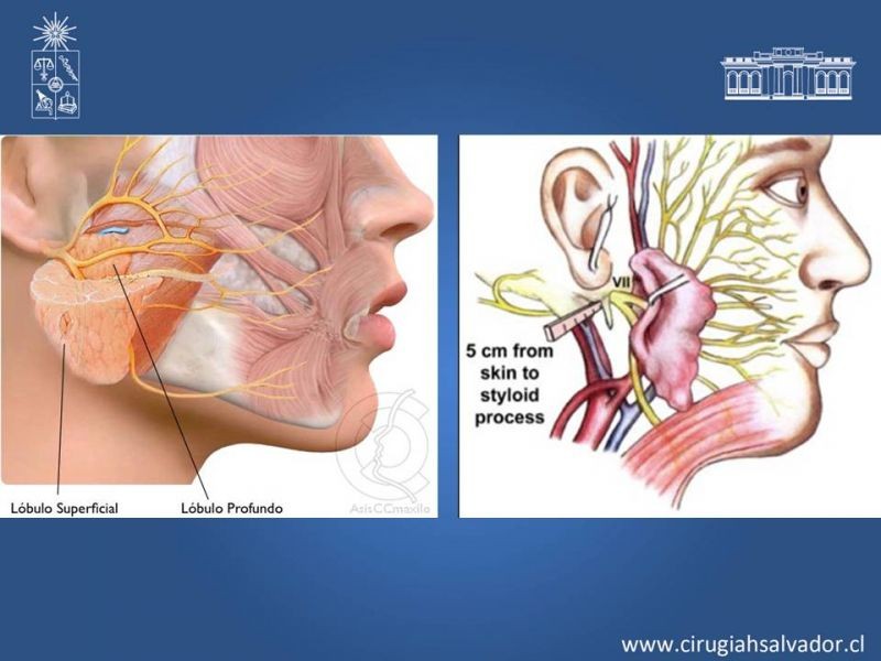 Diapositiva 2 de Tumores de parótida