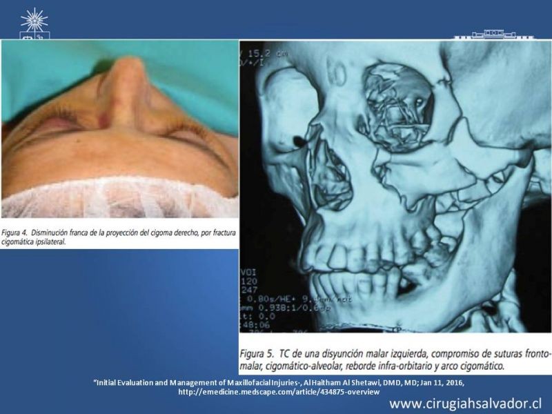 Diapositiva 13 de Trauma maxilofacial