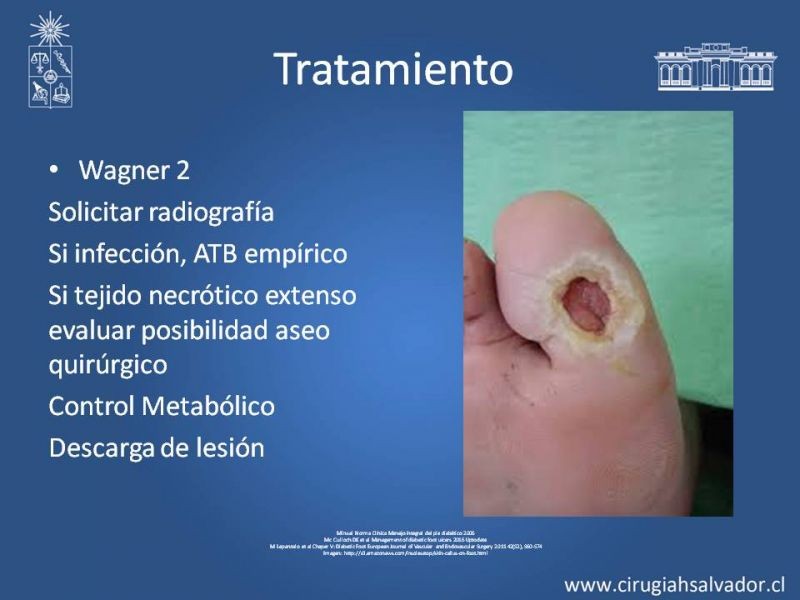 Diapositiva 11 de Pie Diabético