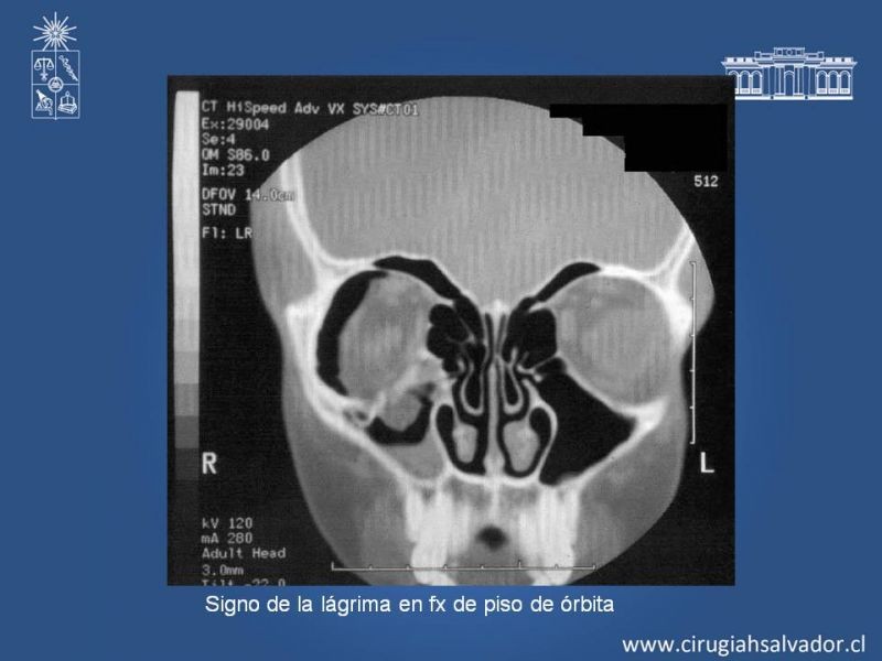 Diapositiva 9 de Trauma maxilofacial