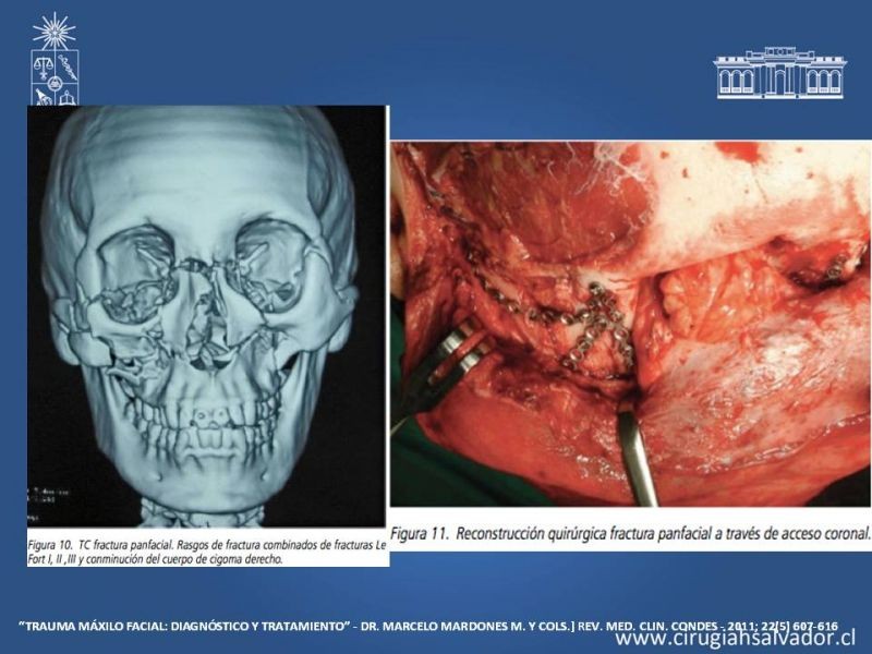 Diapositiva 19 de Trauma maxilofacial
