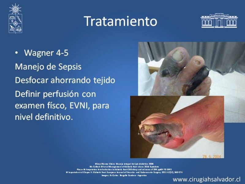 Diapositiva 14 de Pie Diabético
