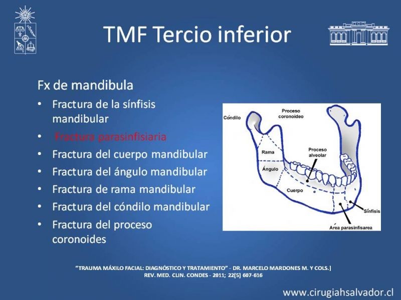 Diapositiva 20 de Trauma maxilofacial