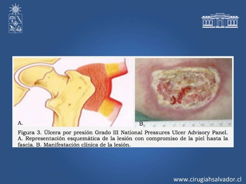 Diapositiva 6 de Manejo quirúrgico de las úlceras por presión