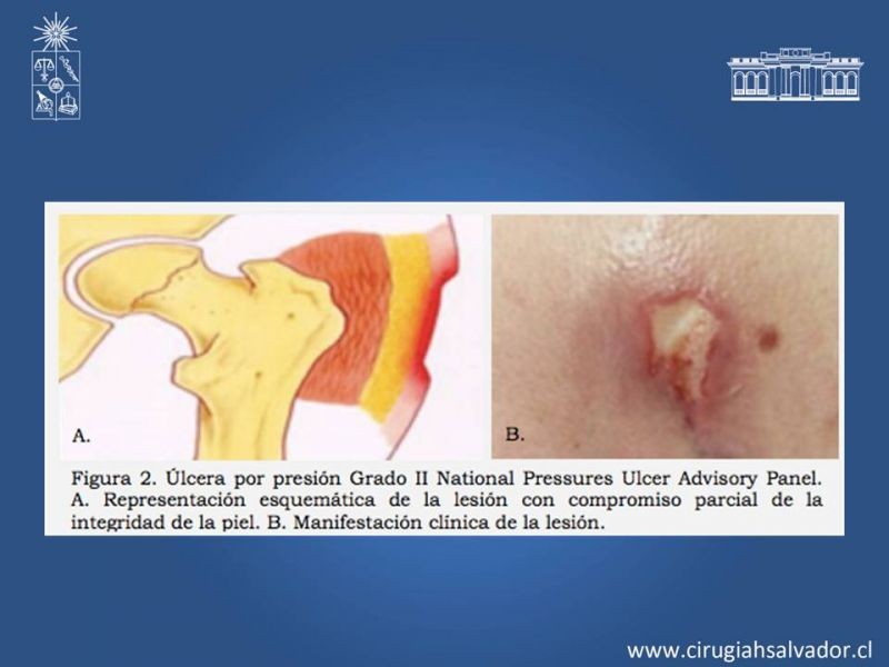 Diapositiva 5 de Manejo quirúrgico de las úlceras por presión