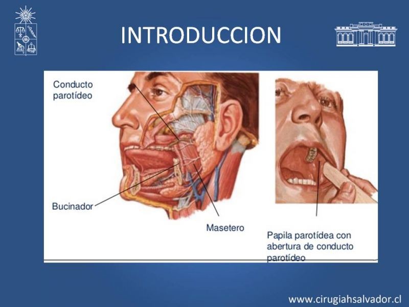 Diapositiva 1 de Tumores de parótida