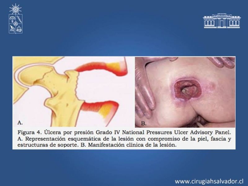 Diapositiva 7 de Manejo quirúrgico de las úlceras por presión