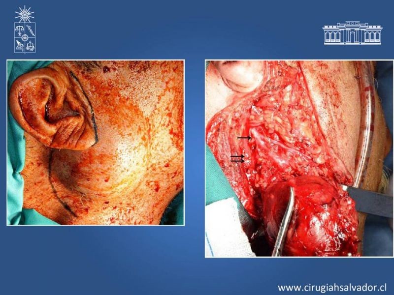 Diapositiva 22 de Tumores de parótida