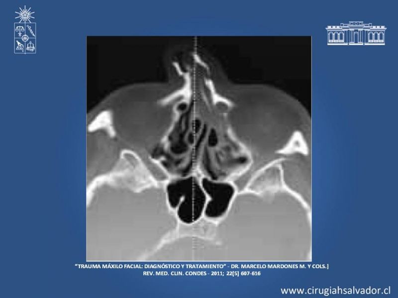 Diapositiva 6 de Trauma maxilofacial