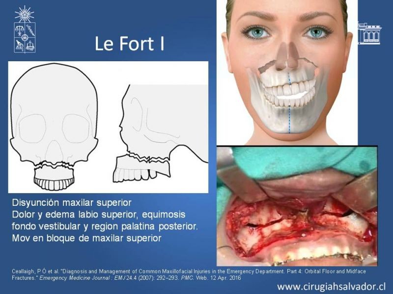 Diapositiva 15 de Trauma maxilofacial