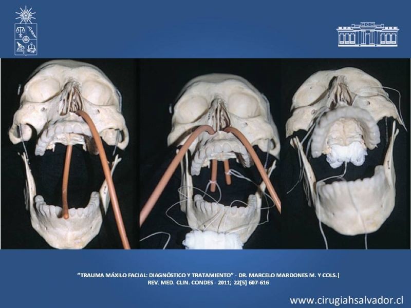 Diapositiva 7 de Trauma maxilofacial