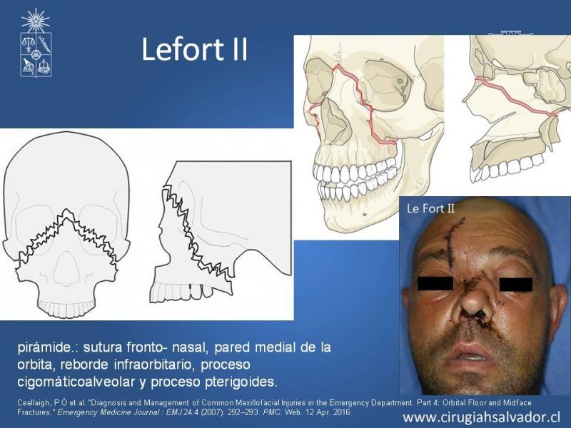 Diapositiva 16 de Trauma maxilofacial