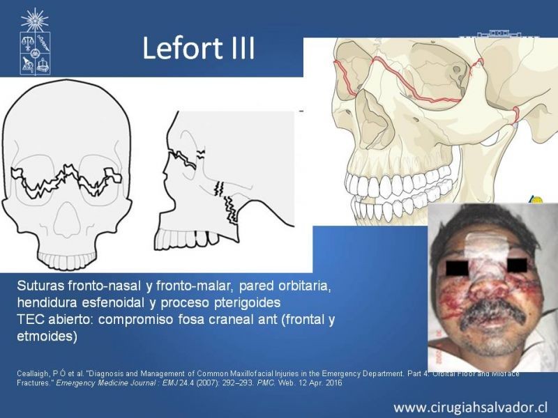 Diapositiva 17 de Trauma maxilofacial