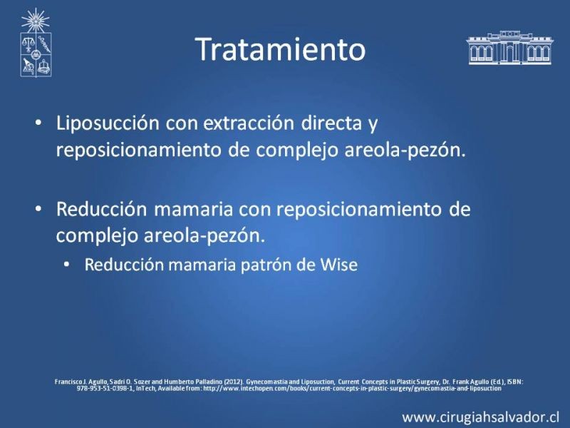 Diapositiva 21 de Ginecomastia