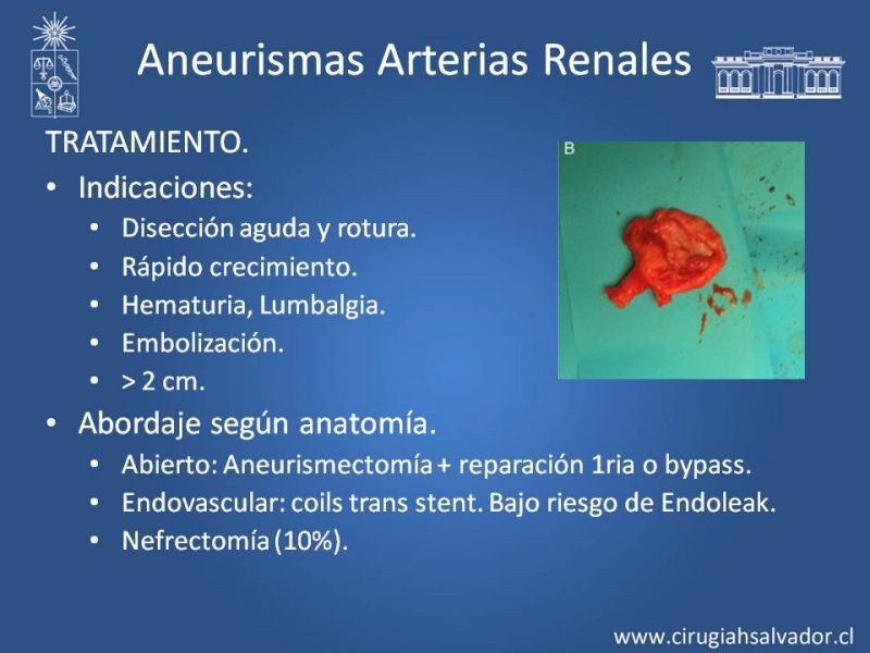 Diapositiva 42 de Aneurismas Periféricos