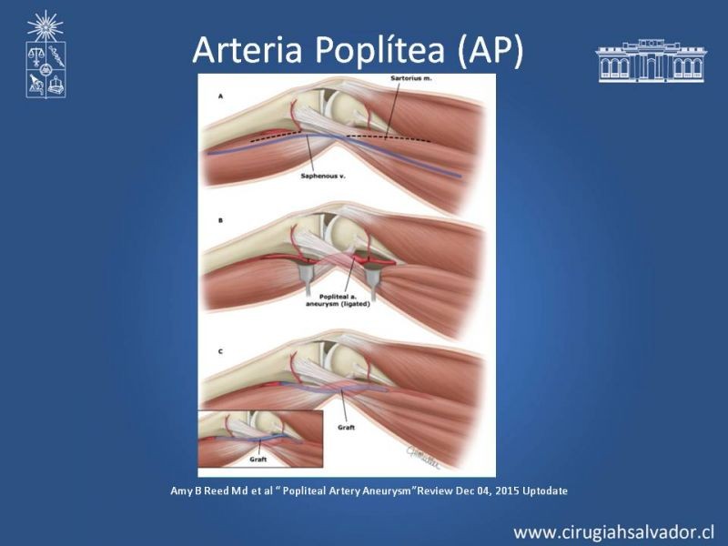 Diapositiva 14 de Aneurismas Periféricos