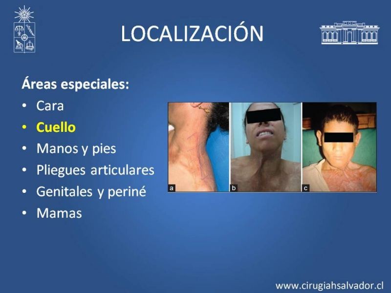 Diapositiva 26 de Gran quemado