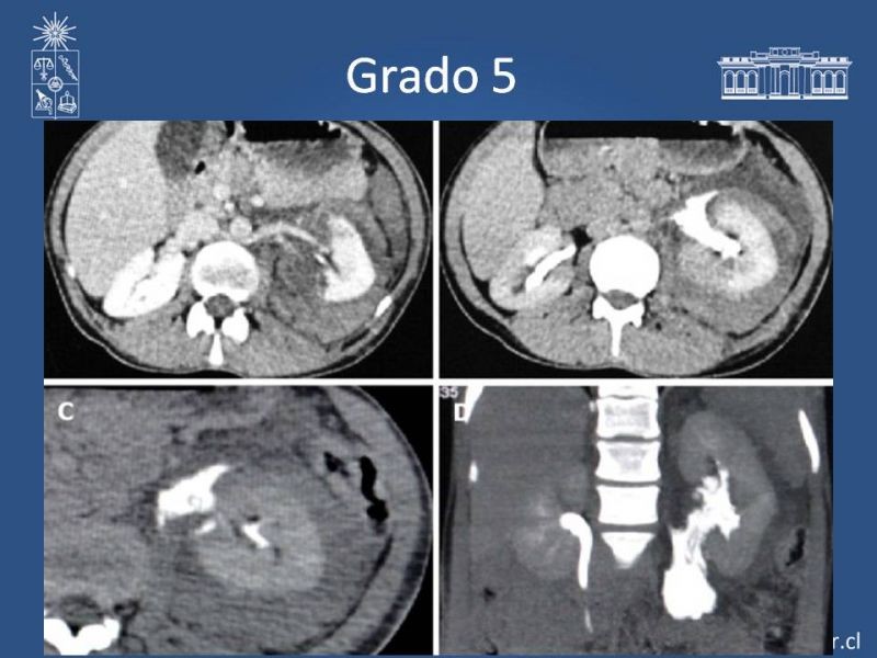 Diapositiva 12 de Lesiones de vía urinaria