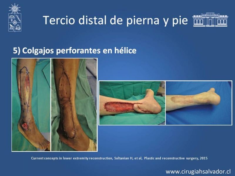 Diapositiva 45 de Cobertura miembro inferior