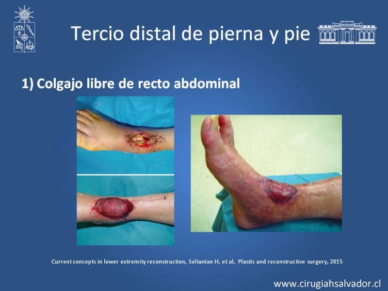 Diapositiva 39 de Cobertura miembro inferior