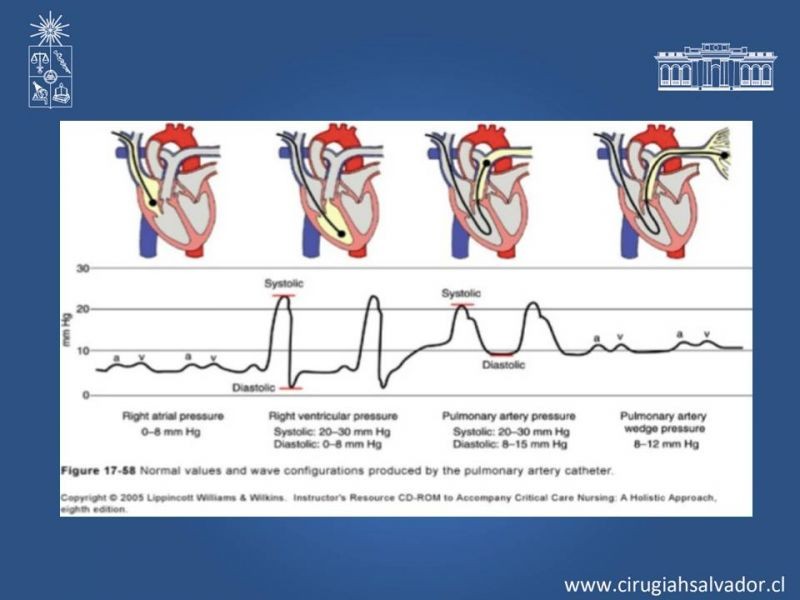 Diapositiva 7 de Catéter de Swan-Ganz y patrones hemodinámicos del shock