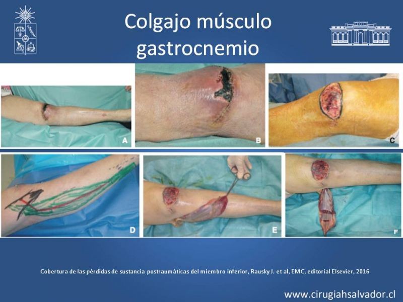 Diapositiva 20 de Cobertura miembro inferior