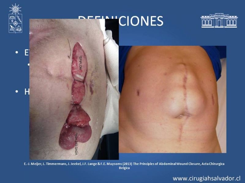 Diapositiva 2 de Cierre pared abdominal y prevención de eventración