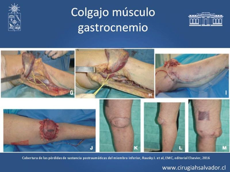 Diapositiva 21 de Cobertura miembro inferior